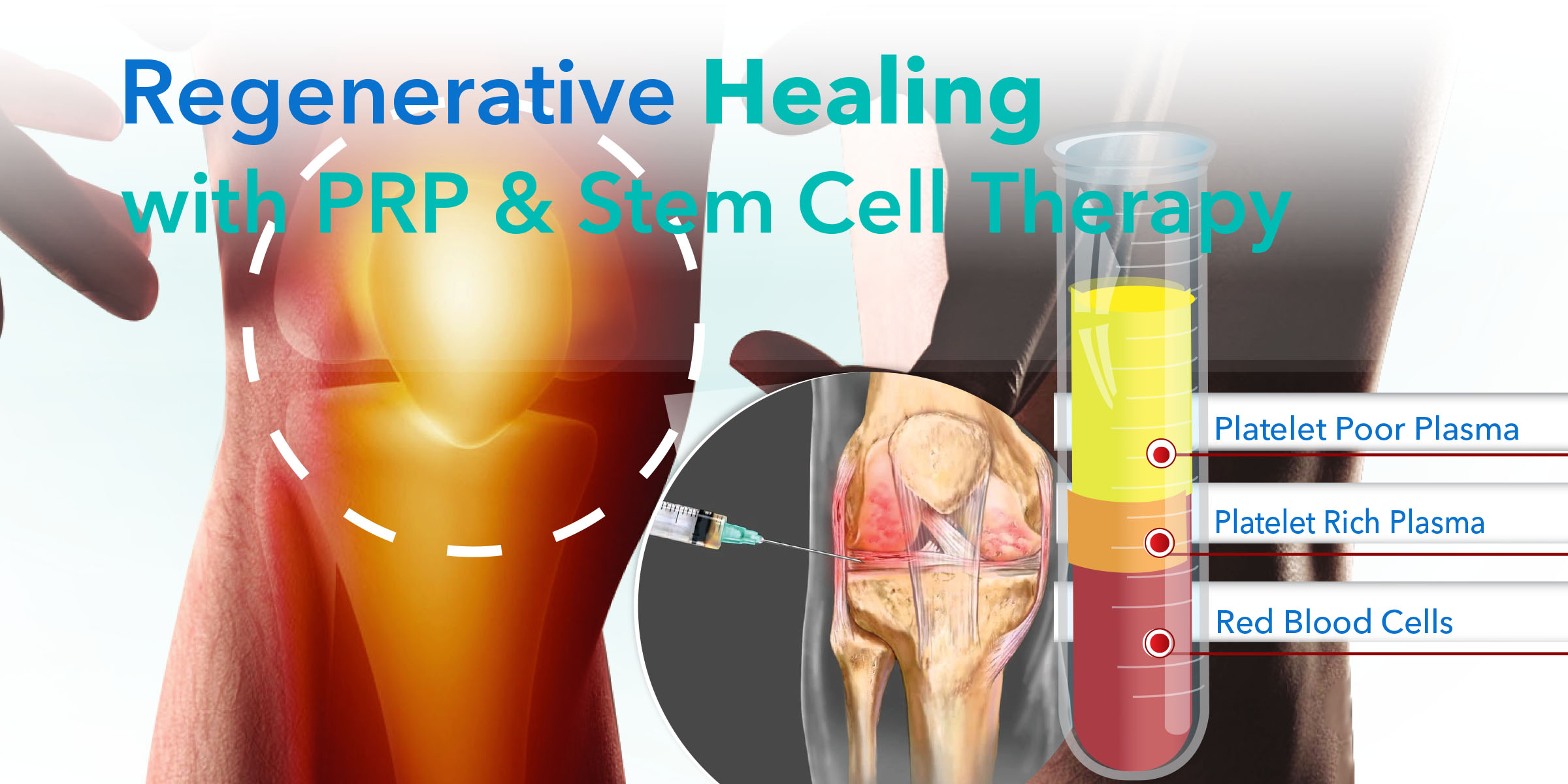 End Joint Pain With Minimally Invasive Platelet Rich Plasma (PRP) And ...